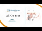 All on Four Cancun - Dental Tourism Mexico