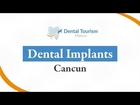 Dental Implants Cancun